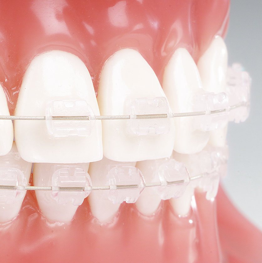 Reflections Ceramic Brackets Brackets TOC Dental