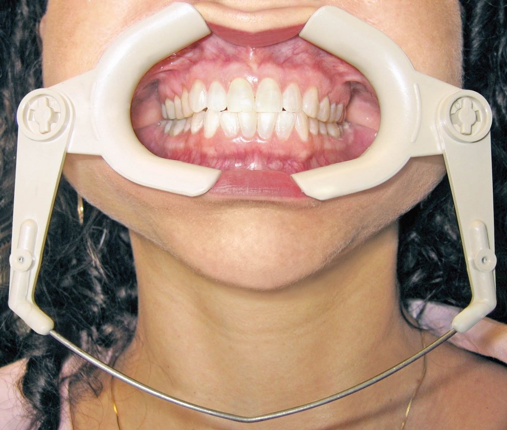 High Heat Cheek Retractor Cheek Retractors TOC Dental