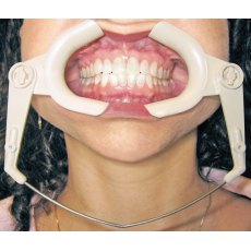 High Heat Cheek Retractor