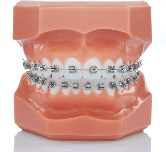 Experience Metal Metal Bracket Systems TOC Dental