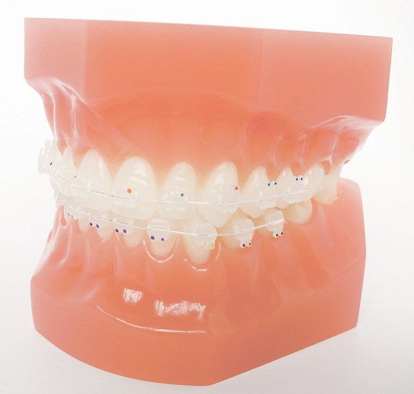 Verve Ceramic Individuals - Aesthetic Bracket Systems - TOC Dental